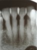 Fig 7. Use of 38% SDF to arrest root caries in permanent teeth of an elderly patient: the lower incisors were responsive to electric pulp testing with no radiographic pathology.
