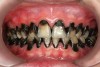Fig 9. Use of 38% SDF to arrest rampant caries in a young teenager: frontal view of arrested caries after consecutive application of SDF for 3 weeks. (image from Chu, et al, 2014, ref 36 [reprinted with approval])