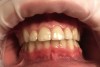 Fig 11. Postoperative 1-month photograph of the patient, without follow-up at-home whitening.