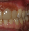 Fig 7. A floating papilla is an artificial papilla that overlaps an adjacent natural tooth.