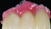 Fig 7. All-ceramic fixed partial denture with layered pink composite prior to elimination of flash and polishing.