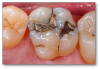 Fig 8. Cracked-tooth syndrome.
