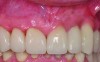 Fig 8. Clinical appearance of the ceramic fixed partial denture: superficial application of pink composite allowed color blending with the surrounding gingival framework.
