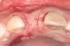 Fig 1. Case 1: A horizontal releasing incision across the edentate ridge at the site of tooth No. 8. It terminates 1 mm from the adjacent teeth.