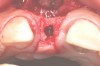 Fig 3. Osteotomy drilled into the ridge, occlusal view.
