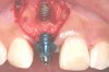 Fig 4. Implant inserted into the ridge, buccal view. There was a large labial concavity. The implant is seen on the buccal and terminates within the alveolar bone.