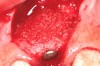 Fig 5. Bone graft placed over the implant on the buccal aspect.