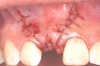 Fig 7. Vertical releasing incisions sutured to attain primary closure, buccal view.