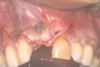 Fig 9. This image shows an example of vertical releasing incisions that are extended laterally across the mucogingival junction of adjacent teeth to attain better access and facilitate large graft procedures.