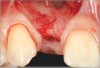 Fig 13. A buccal pedicle flap was elevated, exposing the buccal bony plate.