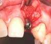 Fig 22. A straight healing abutment was attached to the implant. The barrier (held back with the periosteal elevator) was placed before the bone graft insertion.