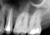 Fig 4. Postoperative final fill.