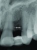 Fig 25. Preoperative radiograph. Congenitally missing tooth No. 10 presents limited space mesiodistally for a conventional implant diameter.