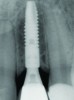 Fig 26. Postoperative radiograph. A small-diameter implant (3 mm) was ideally placed 3-dimensionally.