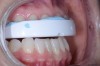Fig 3. Interim dental splint used to help minimize inflammation and stress in the joints and muscles.
