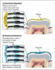 Figure 6. Demineralization/Remineralization.
(A) Plaque acids cause a demineralized, sub-surface lesion. (B) Fluoride treatments remineralize the lesion with a more resistant fluorapatite.