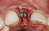 Fig 9. After 3 months of healing, the implant was uncovered. A crestal incision was made with a palatal bias and rolled to the labial side to increase the soft tissue to the facial aspect.