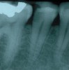 Fig 3. Determining a diagnosis with a radiograph only can lead the clinician to treat tooth No. 29 because of the distal decay. However, if the proper diagnostic tests are performed on tooth No. 29, it should reveal the pulp tested necrotic and it is tooth No. 30 that has a symptomatic irreversible pulpitis.