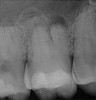 Fig 19. Preoperative radiograph of a case demonstrating apical periodontitis. Courtesy of Dr. Allen Ali Nasseh.