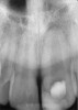 Fig 1. Preoperative radiograph showing apical bone loss.