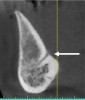 Fig 10. Lingual foramen: cross-sectional view. Arrow indicates location where the lingual vessels in the floor of the mouth enter the mandible.