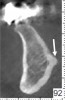 Fig 12. Superior and inferior genial tubercles: cross-sectional view. These are sites where the genioglossus (superior) and geniohyoid (inferior) muscles attach. Arrow is pointing to the superior aspect of the superior genial tubercle.