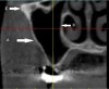 Fig 14. Maxillary sinus: cross-sectional view. A: Buccal wall. B: Medial wall. C: Zygomatic arch.