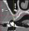 Fig 19. Maxillary sinus: cross-sectional view. A: Blood vessel (radiolucent line) in buccal wall of sinus. B: Septa can appear on any wall of the sinus; they usually do not compartmentalize the sinus. In this slice, this septum of bone appears to originate from the medial sinus wall and project part-way towards the buccal aspect of the sinus; however, multiple adjacent slices should be inspected (in addition to panoramic and axial views) to understand the complete anatomy of a septum.