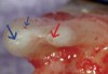 Fig. 6 High-magnification view of mesio–buccal (blue arrow) and mesio–palatal (red arrow) roots. Small blue arrow marks another foramen emanating from the MB system.