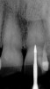 Fig. 23 Radiograph of deeper endo-exploration with the latch grip version of the conical carbide bur. Position confirmed as accurate.