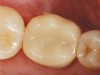 (1.) A CAD/CAM crown restoration without anatomic accentuation.