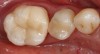 (4.) The final restoration bonded into place using an onlay.