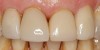 (15.) Two cases in which tooth No. 9 was restored.