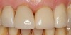 (15.) Two cases in which tooth No. 9 was restored.