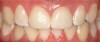 (19.) Two cases of full-coverage crowns for teeth Nos. 8 and 9.