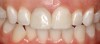 (20.) Two cases of full-coverage crowns for teeth Nos. 8 and 9.