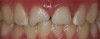 (21.) A patient needed root canals and restoration after a skiing accident.