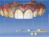 (22.) Design for crowns on teeth Nos. 8 and 9.
