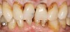 (24.) A 93-year-old patient was unhappy with the appearance of his teeth.