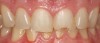 (26.) A patient presented with a large composite filling on tooth No. 9 that had failed or fractured.