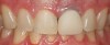 (27.) Dry try-in of the veneer.