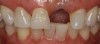 (29.) An implant was placed by a periodontist.