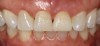 (30.) The clinician scribed some of the texturing seen on tooth No. 8 onto tooth No. 9.