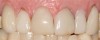 (31.) A patient presented with failing veneers.