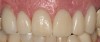 (32.) Final result with full-coverage crowns.