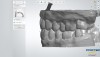 Fig 2. Lateral view (digital) showing articulated casts and buccal angulation of implant.