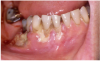 Figure 8 - Oral cancer- Lymphoma Courtesy of Dentalcare.com