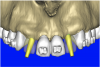 Figure 10b  By using the virtual teeth feature, (A) final implant and abutment positioning was checked, (B) the abutment projection evaluated for a cementable prosthesis, and (C) the appearance of the desired virtual restorations evaluated for emergence and esthetics.