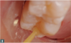 Fig 2. The tubules and demineralized dentin are infiltrated.