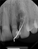 Fig 6. A periapical radiograph can be useful for such factors as demonstrating interradicular distance and contradicting pathology, but it is not always beneficial, such as in the case of this cuspid for implant placement.